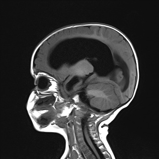 File:Choroid plexus papilloma (Radiopaedia 84612-100019 Sagittal T1 15).jpg