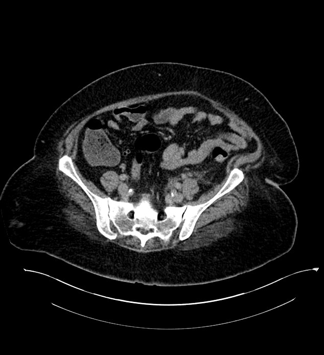 Chromophobe renal cell carcinoma (Radiopaedia 84239-99519 E 117).jpg