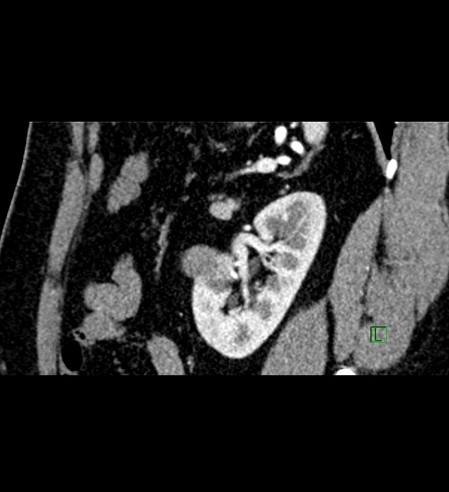 Chromophobe renal cell carcinoma (Radiopaedia 84286-99573 F 47).jpg
