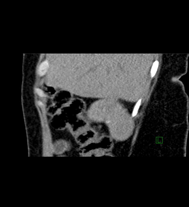 Chromophobe renal cell carcinoma (Radiopaedia 84290-99582 D 80).jpg