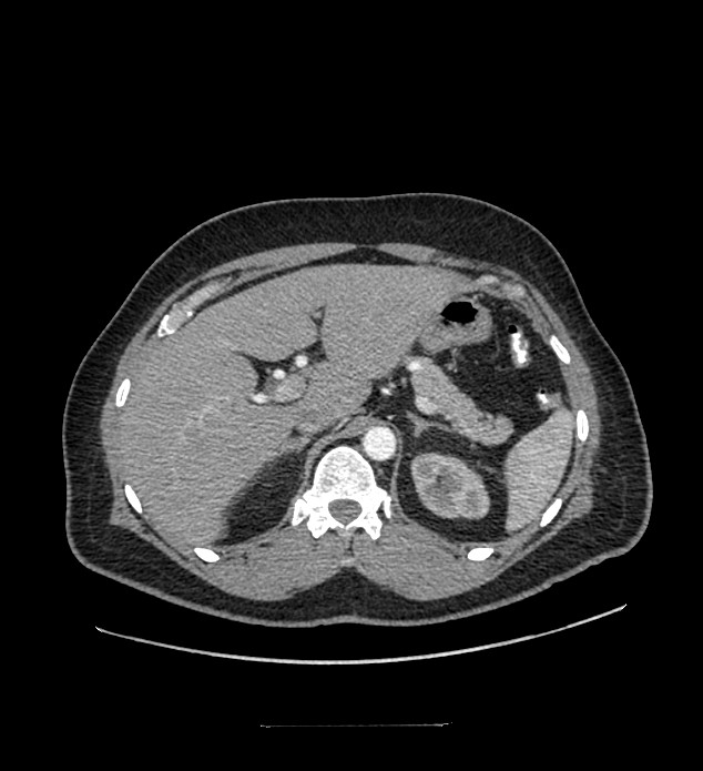 Chromophobe renal cell carcinoma (Radiopaedia 84337-99644 B 25).jpg