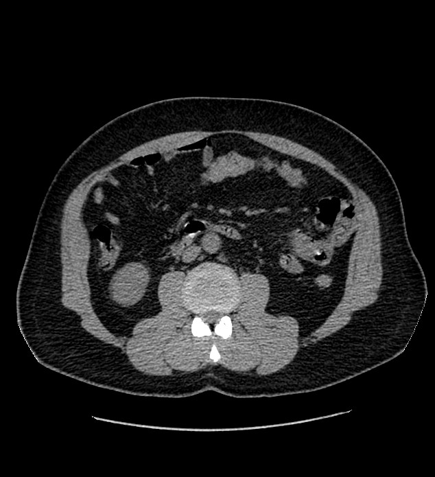 Chromophobe renal cell carcinoma (Radiopaedia 84337-99693 Axial non-contrast 71).jpg