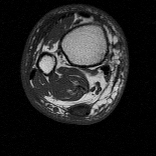 File:Chronic Achilles tendon rupture (Radiopaedia 15262-15100 Axial T1 4).jpg