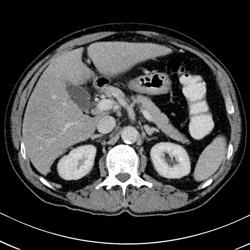 Chronic appendicitis complicated by appendicular abscess, pylephlebitis and liver abscess (Radiopaedia 54483-60700 B 53).jpg