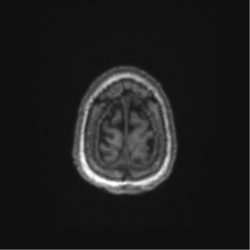 Chronic hypertensive encephalopathy (Radiopaedia 72844-83495 Axial T1 7).png