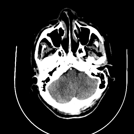 Chronic invasive fungal sinusitis (Radiopaedia 91563-109286 B 13).jpg