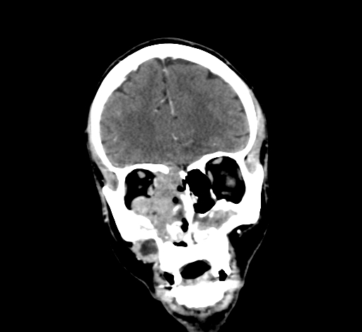 Chronic invasive fungal sinusitis with intraorbital and intracranial extension (Radiopaedia 56387-63046 C 100).jpg