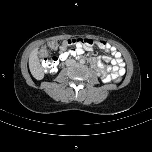 Chronic pancreatitis (Radiopaedia 64576-73450 C 90).jpg
