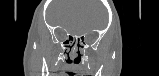 Chronic sphenoidal sinusitis (Radiopaedia 62030-70122 Coronal bone window 87).jpg
