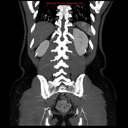 File:Circumaortic left renal vein (Radiopaedia 9069-9792 B 36).jpg
