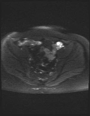 Class II Mullerian duct anomaly- unicornuate uterus with rudimentary horn and non-communicating cavity (Radiopaedia 39441-41755 Axial DWI 10).jpg