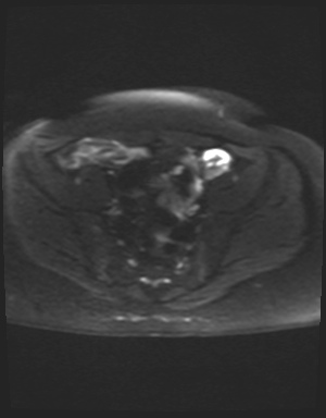 Class II Mullerian duct anomaly- unicornuate uterus with rudimentary horn and non-communicating cavity (Radiopaedia 39441-41755 Axial DWI 9).jpg