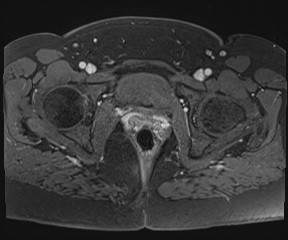 File:Class II Mullerian duct anomaly- unicornuate uterus with rudimentary horn and non-communicating cavity (Radiopaedia 39441-41755 Axial T1 fat sat 109).jpg