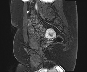 File:Class II Mullerian duct anomaly- unicornuate uterus with rudimentary horn and non-communicating cavity (Radiopaedia 39441-41755 G 77).jpg