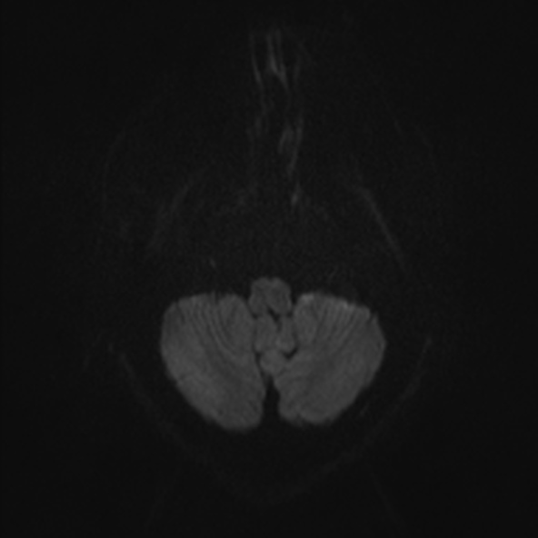 File:Clival meningioma (Radiopaedia 53278-59248 Axial DWI 28).jpg