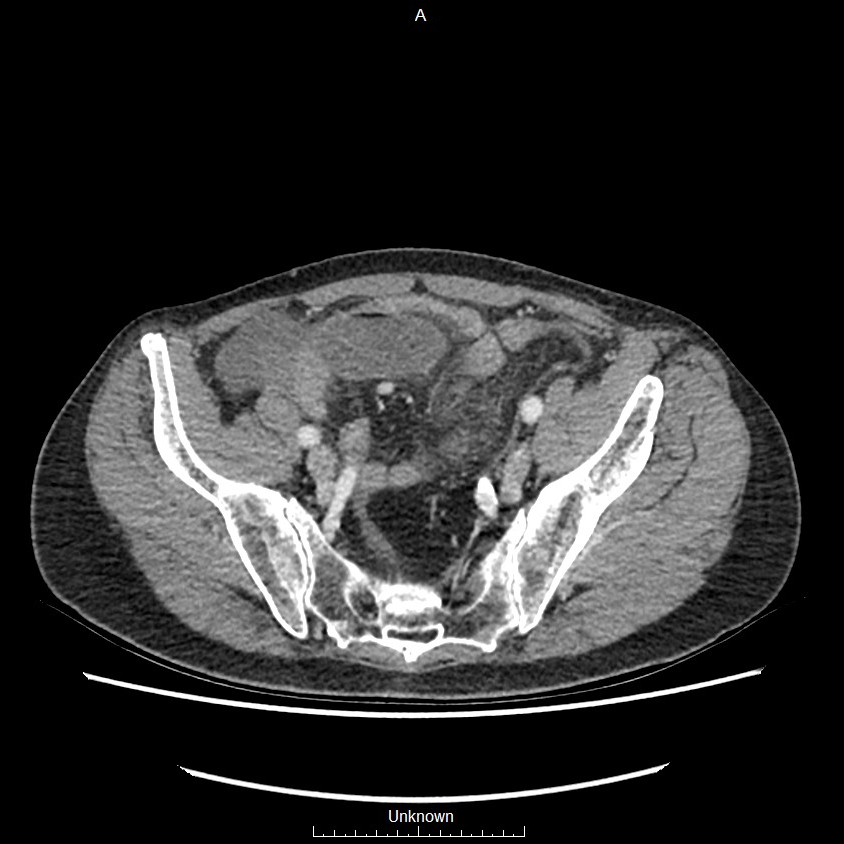 Closed loop bowel obstruction and ischemia (Radiopaedia 86959-103180 A 70).jpg