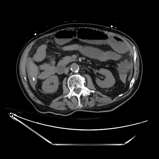 File:Closed loop obstruction due to adhesive band, resulting in small bowel ischemia and resection (Radiopaedia 83835-99023 Axial 75).jpg