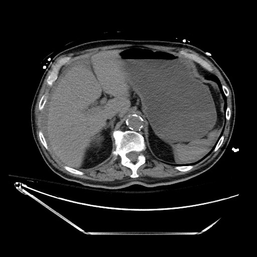 File:Closed loop obstruction due to adhesive band, resulting in small bowel ischemia and resection (Radiopaedia 83835-99023 Axial non-contrast 38).jpg