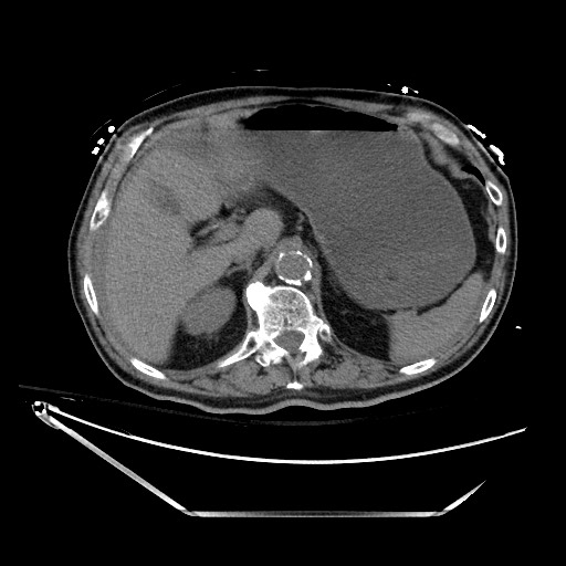 Closed loop obstruction due to adhesive band, resulting in small bowel ischemia and resection (Radiopaedia 83835-99023 Axial non-contrast 41).jpg