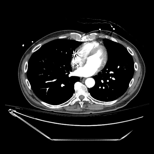 File:Closed loop obstruction due to adhesive band, resulting in small bowel ischemia and resection (Radiopaedia 83835-99023 B 6).jpg