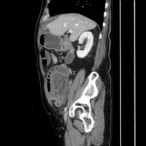 File:Closed loop obstruction due to adhesive band, resulting in small bowel ischemia and resection (Radiopaedia 83835-99023 F 66).jpg