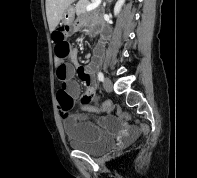 Closed loop small bowel obstruction (Radiopaedia 71211-81508 C 93).jpg