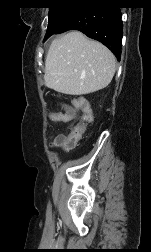 Closed loop small bowel obstruction - adhesions (Radiopaedia 59269-66611 C 91).jpg