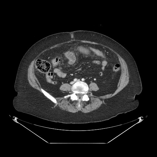 Closed loop small bowel obstruction - internal hernia (Radiopaedia 65402-74450 A 80).jpg