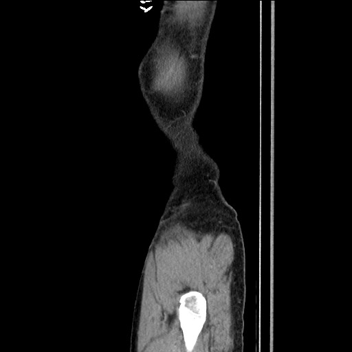 Closed loop small bowel obstruction - omental adhesion causing "internal hernia" (Radiopaedia 85129-100682 C 172).jpg