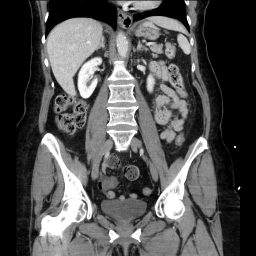 File:Closed loop small bowel obstruction due to adhesive bands - early and late images (Radiopaedia 83830-99014 B 71).jpg