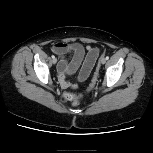 Closed loop small bowel obstruction due to adhesive bands - early and late images (Radiopaedia 83830-99015 A 147).jpg