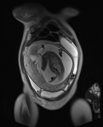 File:Closed loop small bowel obstruction in pregnancy (MRI) (Radiopaedia 87637-104031 Coronal T2 16).jpg