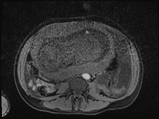 Closed loop small bowel obstruction in pregnancy (MRI) (Radiopaedia 87637-104031 F 8).jpg