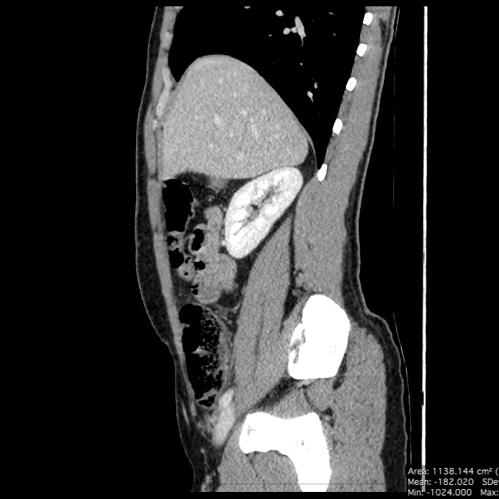 Co-existing acute appendicitis and epiploic appendagitis (Radiopaedia 61789-69911 B 28).jpg
