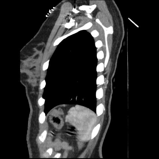 File:Coarctation of the aorta (Radiopaedia 67609-77010 C 10).jpg