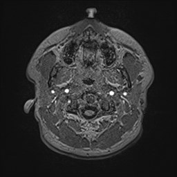 File:Cochlear incomplete partition type III associated with hypothalamic hamartoma (Radiopaedia 88756-105498 Axial T1 18).jpg