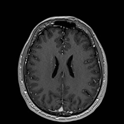 Cochlear incomplete partition type III associated with hypothalamic hamartoma (Radiopaedia 88756-105498 Axial T1 C+ 126).jpg