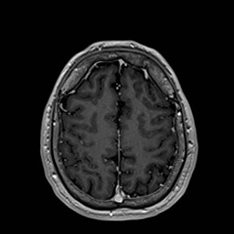 File:Cochlear incomplete partition type III associated with hypothalamic hamartoma (Radiopaedia 88756-105498 Axial T1 C+ 152).jpg