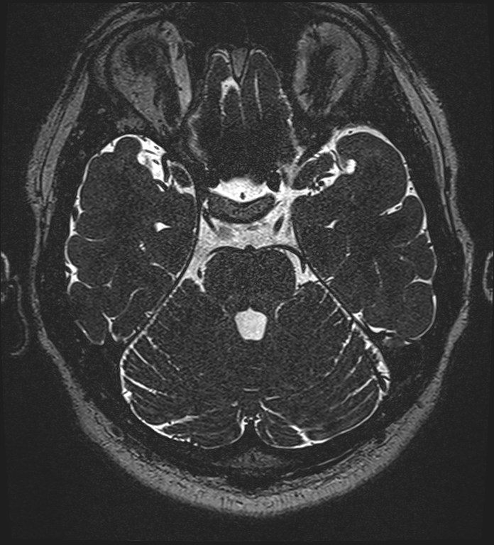 Cochlear incomplete partition type III associated with hypothalamic hamartoma (Radiopaedia 88756-105498 Axial T2 116).jpg