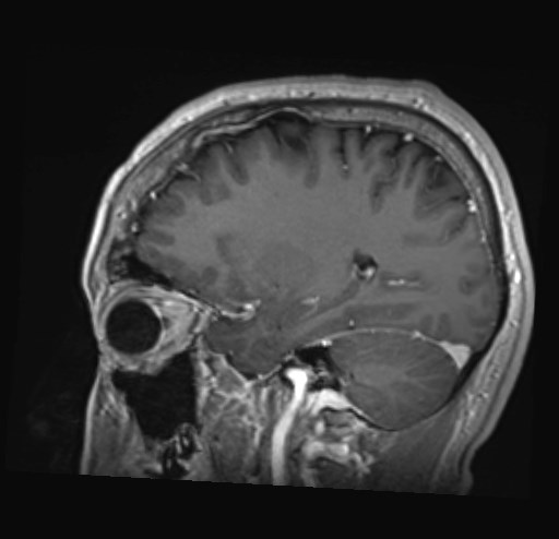 Cochlear incomplete partition type III associated with hypothalamic hamartoma (Radiopaedia 88756-105498 Sagittal T1 C+ 37).jpg