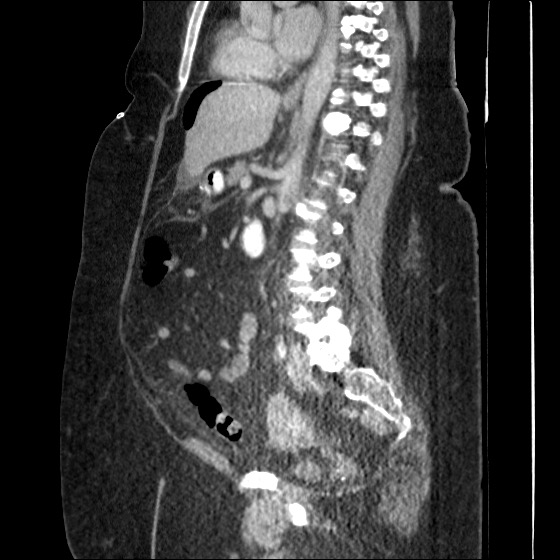 File:Collection due to leak after sleeve gastrectomy (Radiopaedia 55504-61972 C 33).jpg