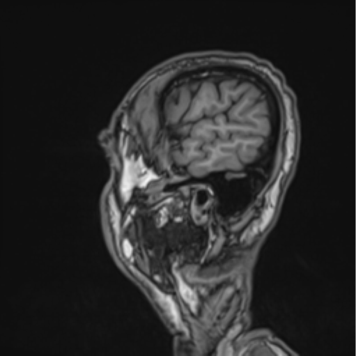 File:Colloid cyst of the third ventricle (Radiopaedia 86571-102662 Sagittal T1 10).png