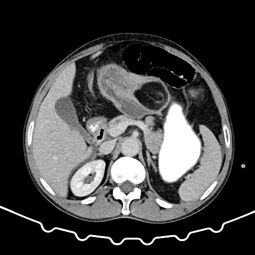 Colocolic intussusception due to large lipoma (Radiopaedia 68773-78482 A 49).jpg