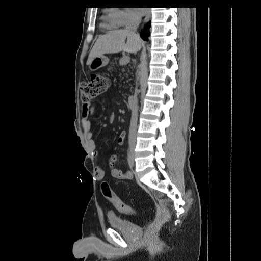 File:Colocutaneous fistula in Crohn's disease (Radiopaedia 29586-30093 C 21).jpg