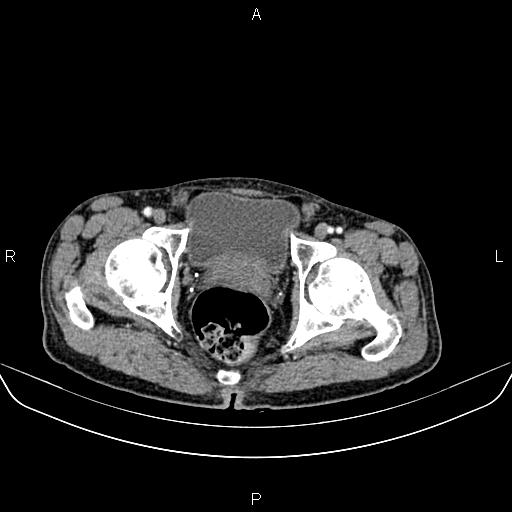 Colon adenocarcinoma - hepatic flexure (Radiopaedia 85635-101395 A 93).jpg