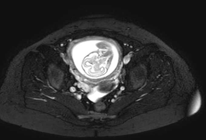 Colon adenocarcinoma with Krukenberg tumors, advanced pregnancy (Radiopaedia 67279-76645 Axial T2 SPAIR 13).jpg