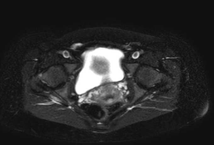 Colon adenocarcinoma with Krukenberg tumors, advanced pregnancy (Radiopaedia 67279-76645 Axial T2 SPAIR 7).jpg