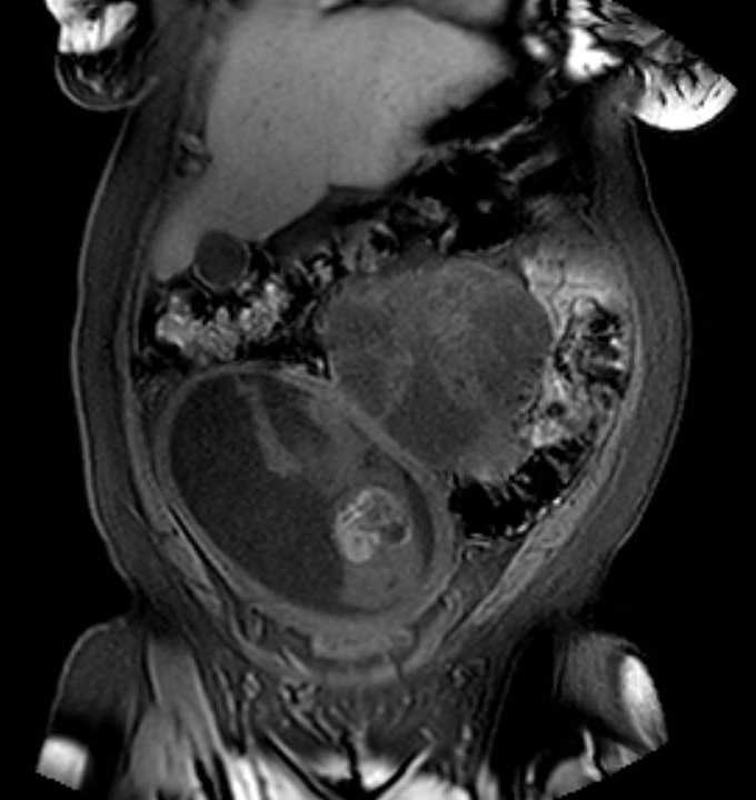 Colon adenocarcinoma with Krukenberg tumors, advanced pregnancy (Radiopaedia 67279-76645 E 19).jpg