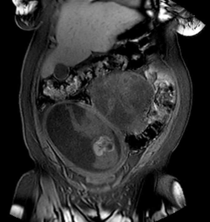 Colon adenocarcinoma with Krukenberg tumors, advanced pregnancy (Radiopaedia 67279-76645 E 20).jpg