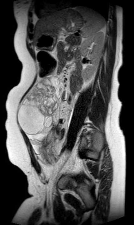 Colon adenocarcinoma with Krukenberg tumors, advanced pregnancy (Radiopaedia 67279-76645 Sagittal T2 19).jpg